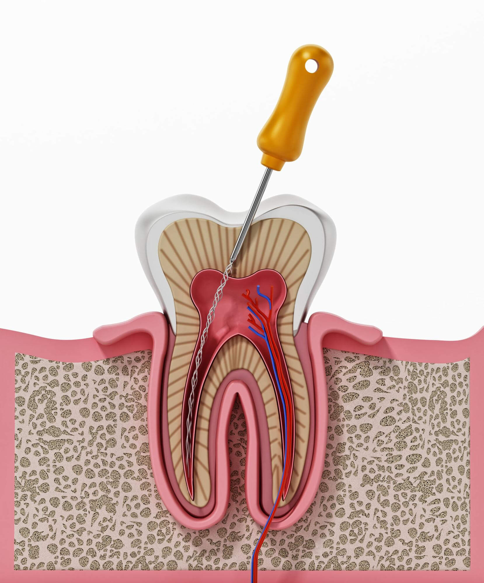 root canal treatment process SADC