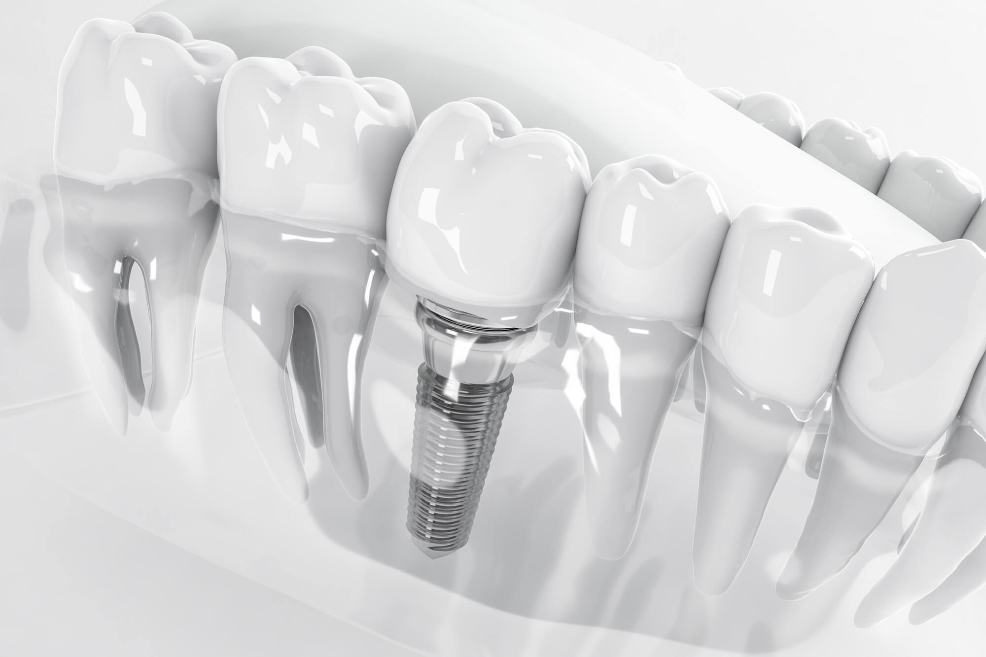 what you need to know before getting dental implants