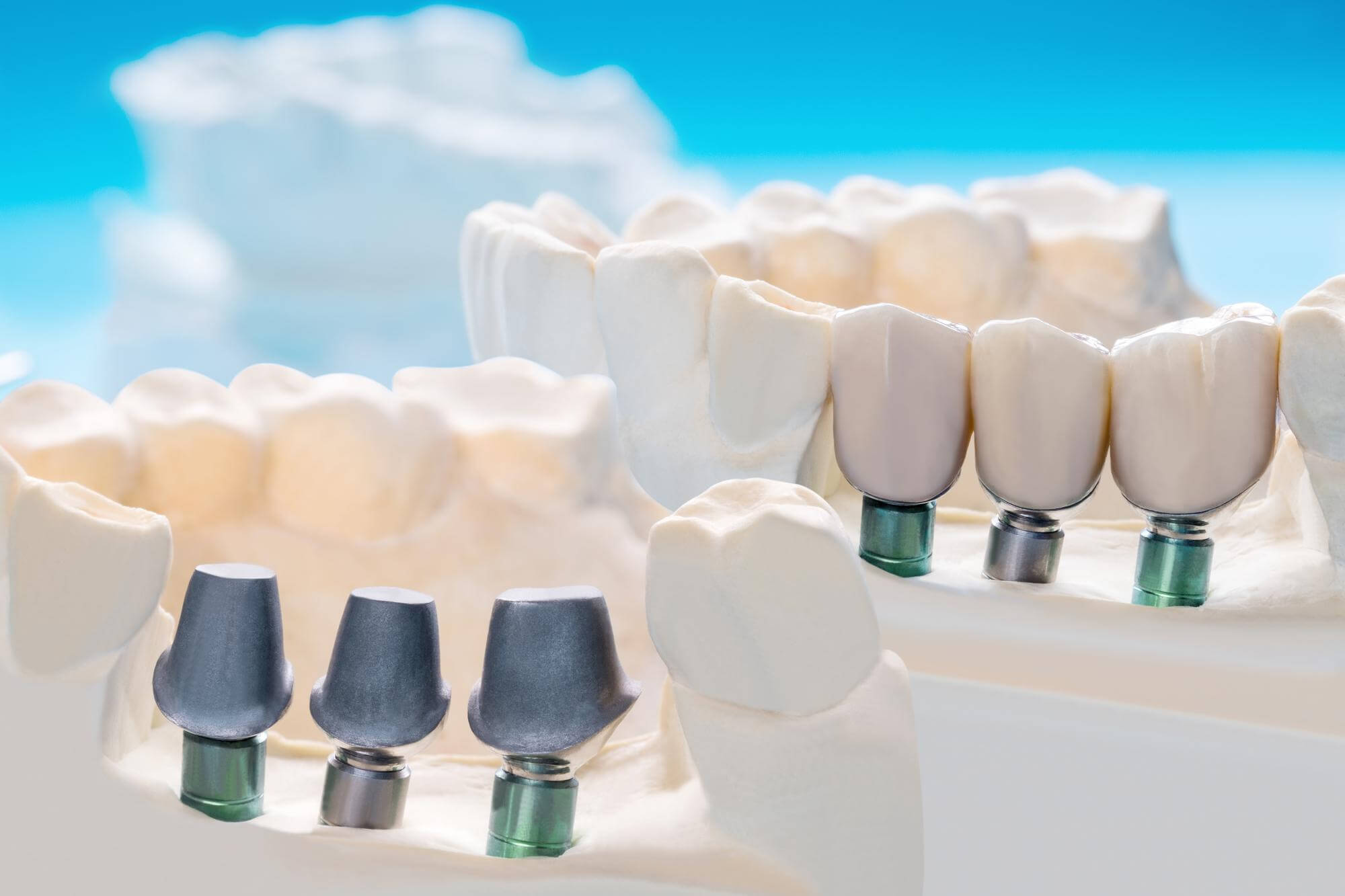 dental implants and crowns model