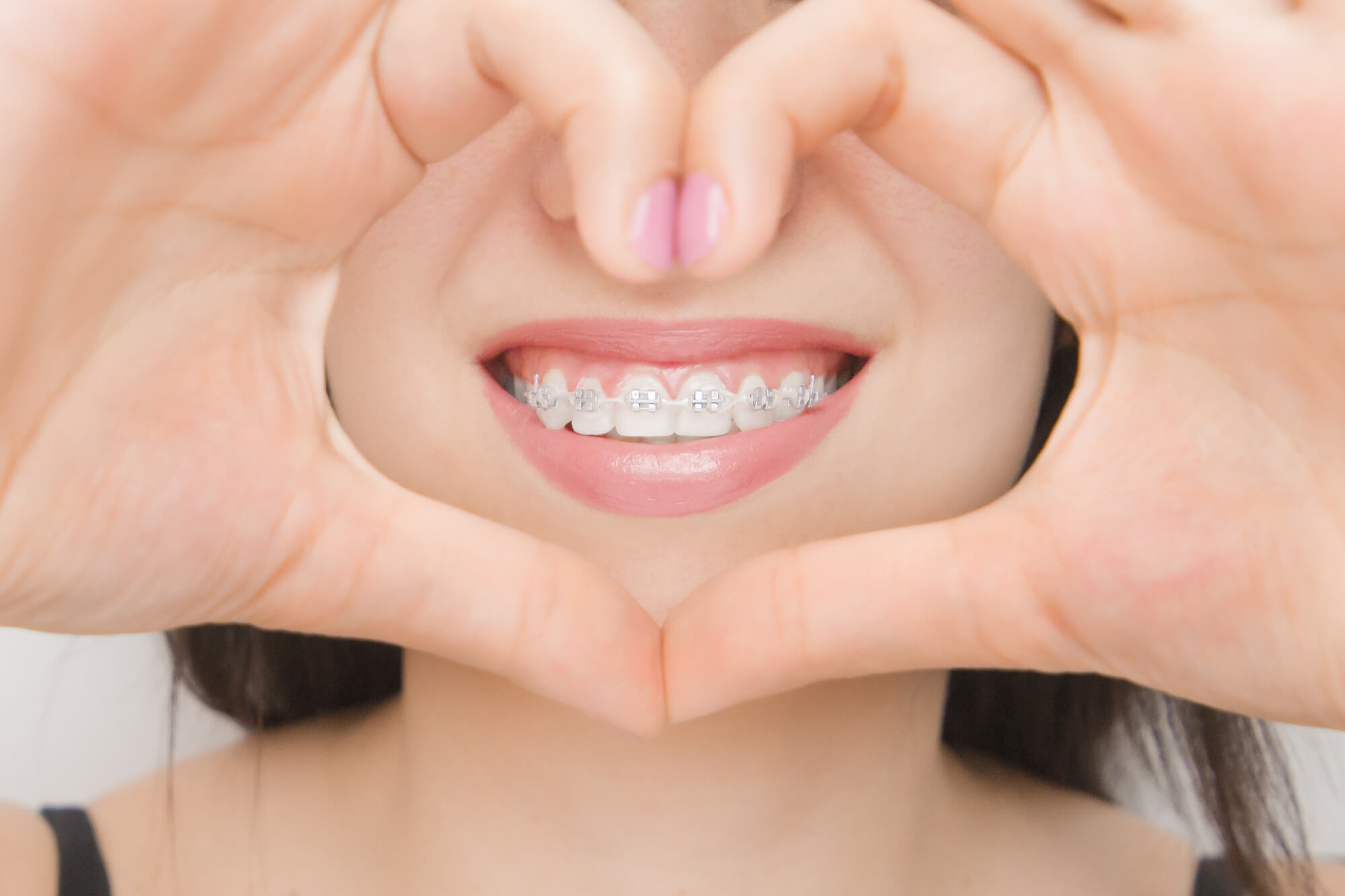 Dental braces happy woman's mouth through heart brackets SADC