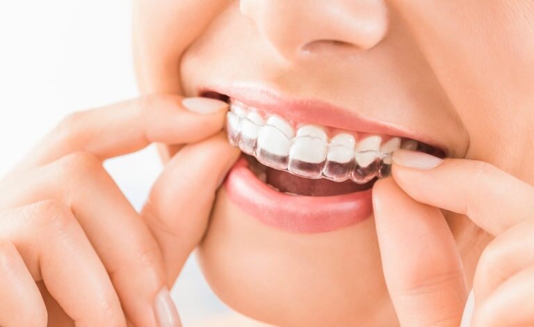 Which Is Better, Invisalign or Braces?