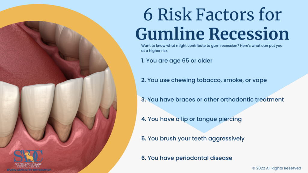 6 Risk Factors for Gumline Recession Infographic
