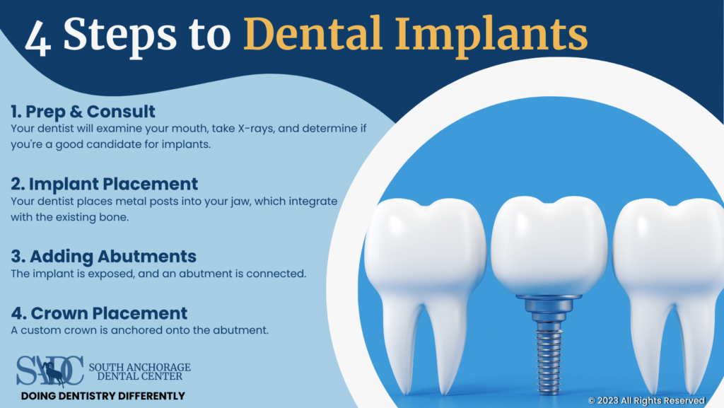 4 Steps to Dental Implants Infographic