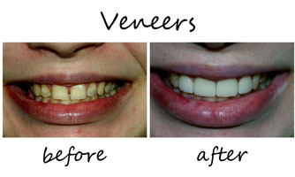 Veneers at South Anchorage Dental Center
