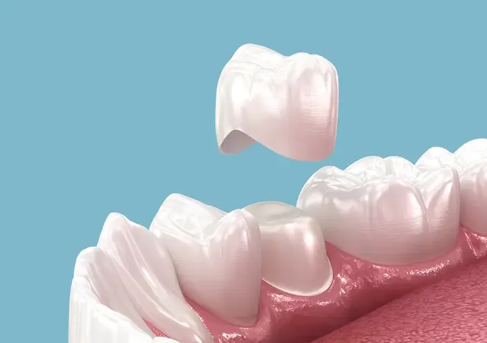 Same Day Dental Crowns at South Anchorage Dental Center
