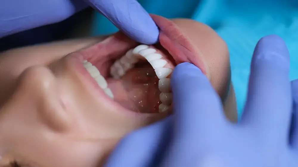 Veneers at South Anchorage Dental Center