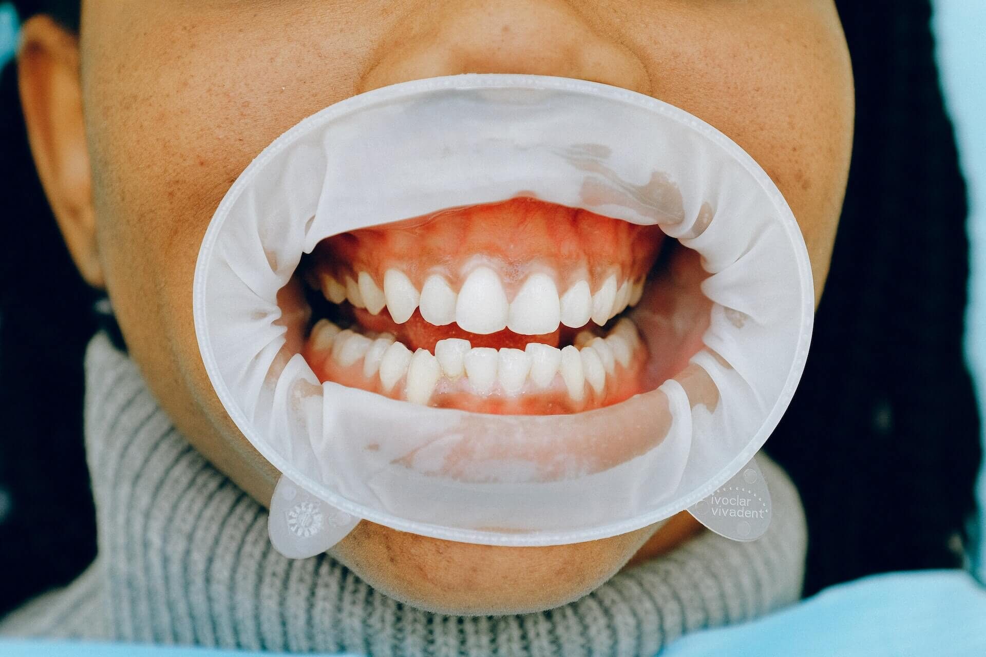 Gum Disease Treatment at South Anchorage Dental Center