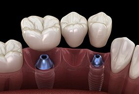 Permanent dental implant solutions in Anchorage AK